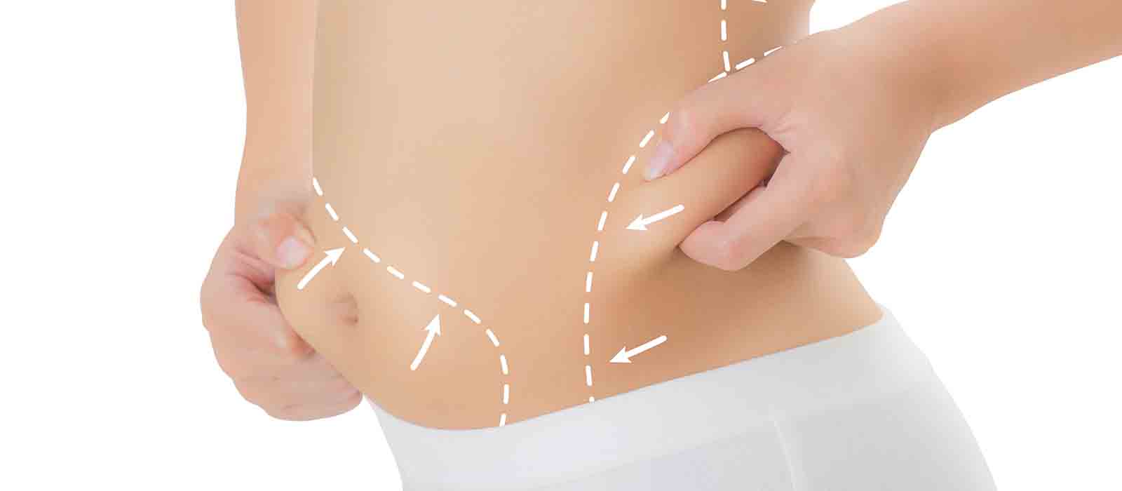 liposuction Perth - Dr Quinn