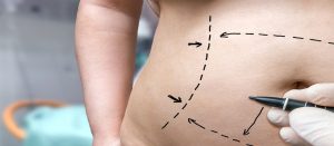 tummy tuck Perth - abdominoplasty Perth